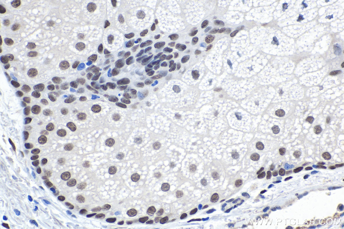 Immunohistochemical analysis of paraffin-embedded human skin cancer tissue slide using KHC1741 (NFIX IHC Kit).