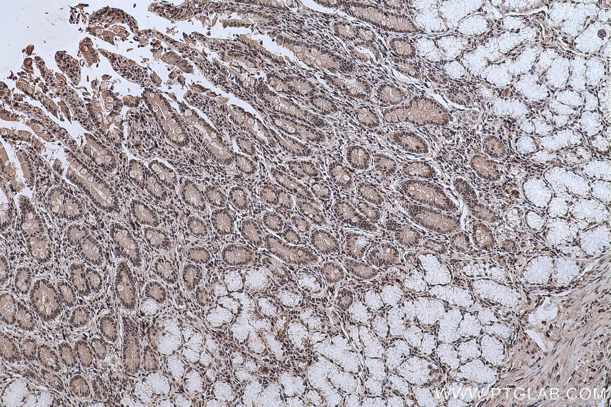 Immunohistochemical analysis of paraffin-embedded human stomach cancer tissue slide using KHC0635 (NFKB1 IHC Kit).
