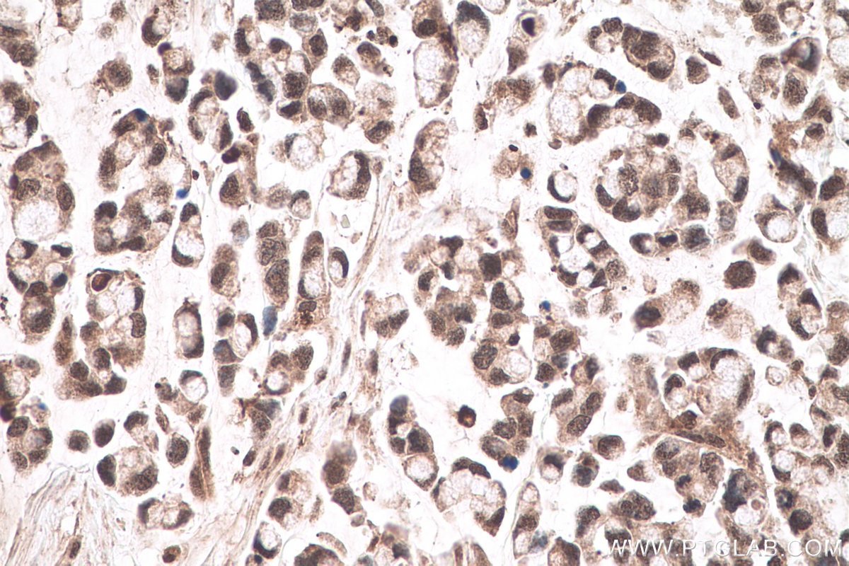 Immunohistochemical analysis of paraffin-embedded human colon cancer tissue slide using KHC0635 (NFKB1 IHC Kit).