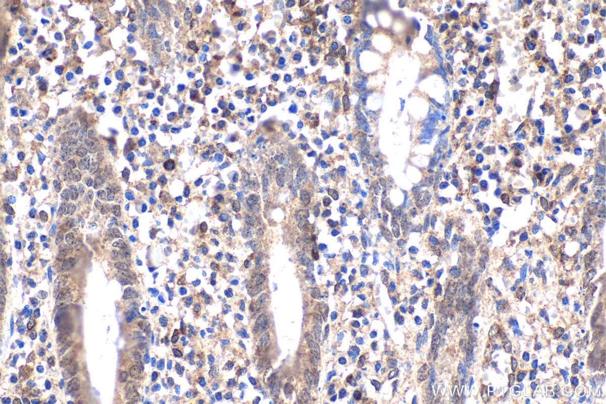 Immunohistochemical analysis of paraffin-embedded human appendicitis tissue slide using KHC1659 (NFKB2 IHC Kit).