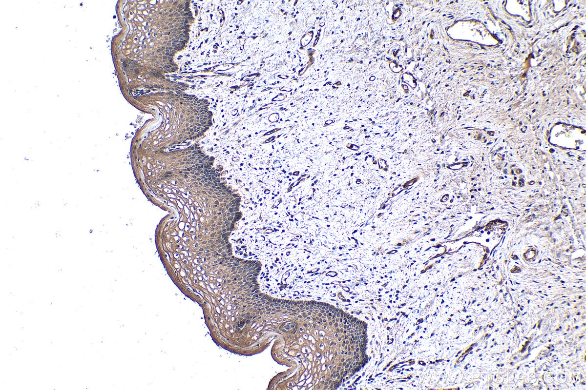 Immunohistochemical analysis of paraffin-embedded human cervical cancer tissue slide using KHC1368 (NFKBIA IHC Kit).