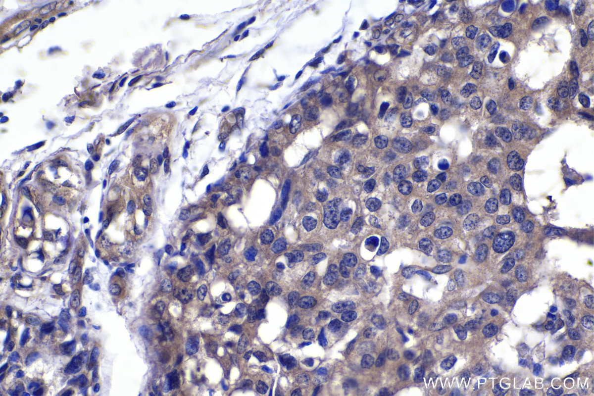 Immunohistochemical analysis of paraffin-embedded human breast cancer tissue slide using KHC1368 (NFKBIA IHC Kit).