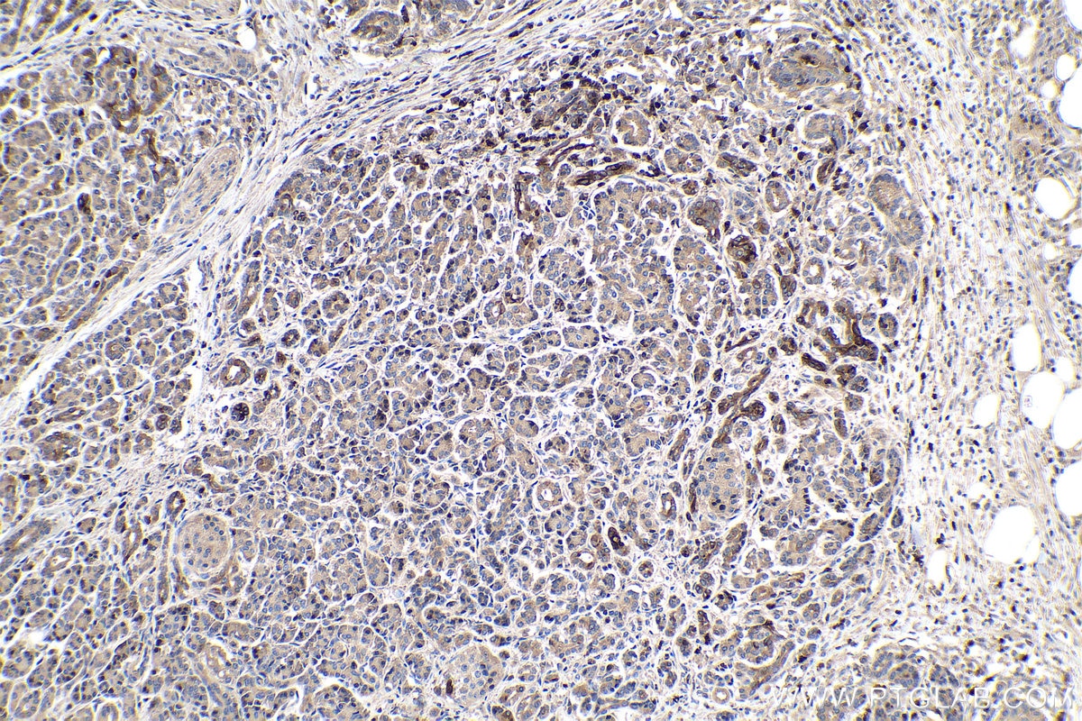 Immunohistochemical analysis of paraffin-embedded human pancreas cancer tissue slide using KHC0307 (NGAL/LCN2 IHC Kit).