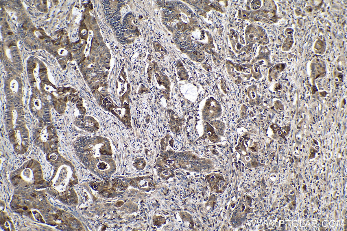 Immunohistochemical analysis of paraffin-embedded human colon cancer tissue slide using KHC0307 (NGAL/LCN2 IHC Kit).