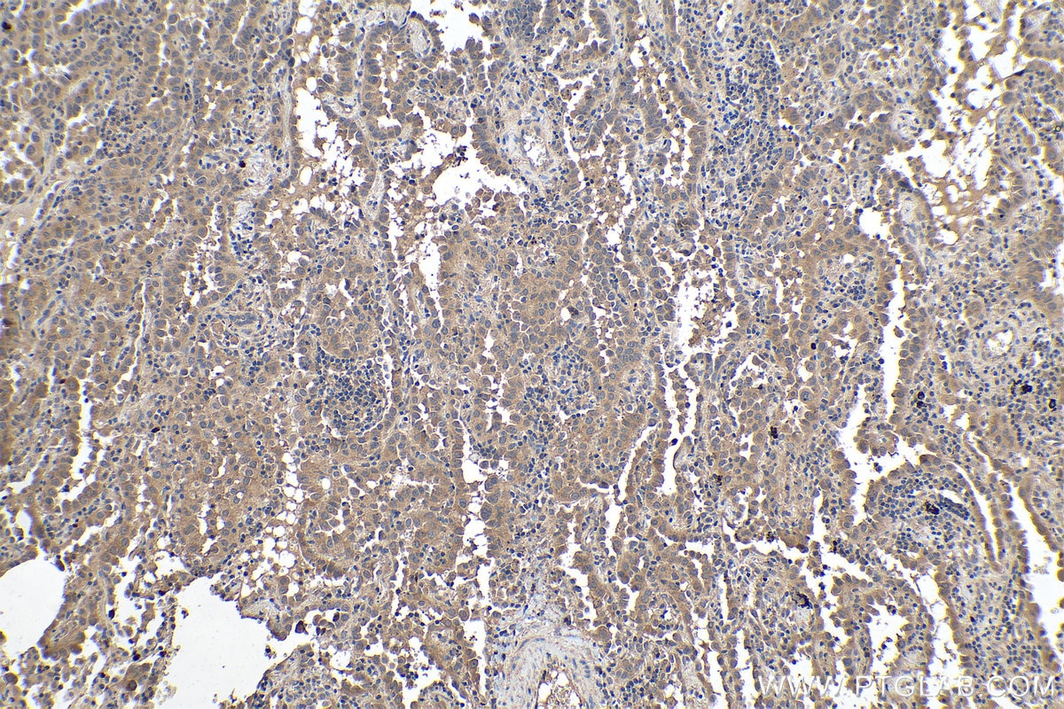 Immunohistochemical analysis of paraffin-embedded human lung cancer tissue slide using KHC0307 (NGAL/LCN2 IHC Kit).