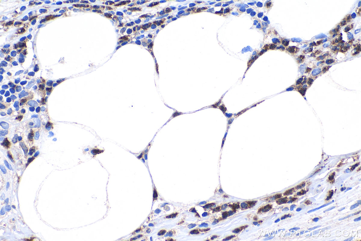 Immunohistochemical analysis of paraffin-embedded human appendicitis tissue slide using KHC0307 (NGAL/LCN2 IHC Kit).