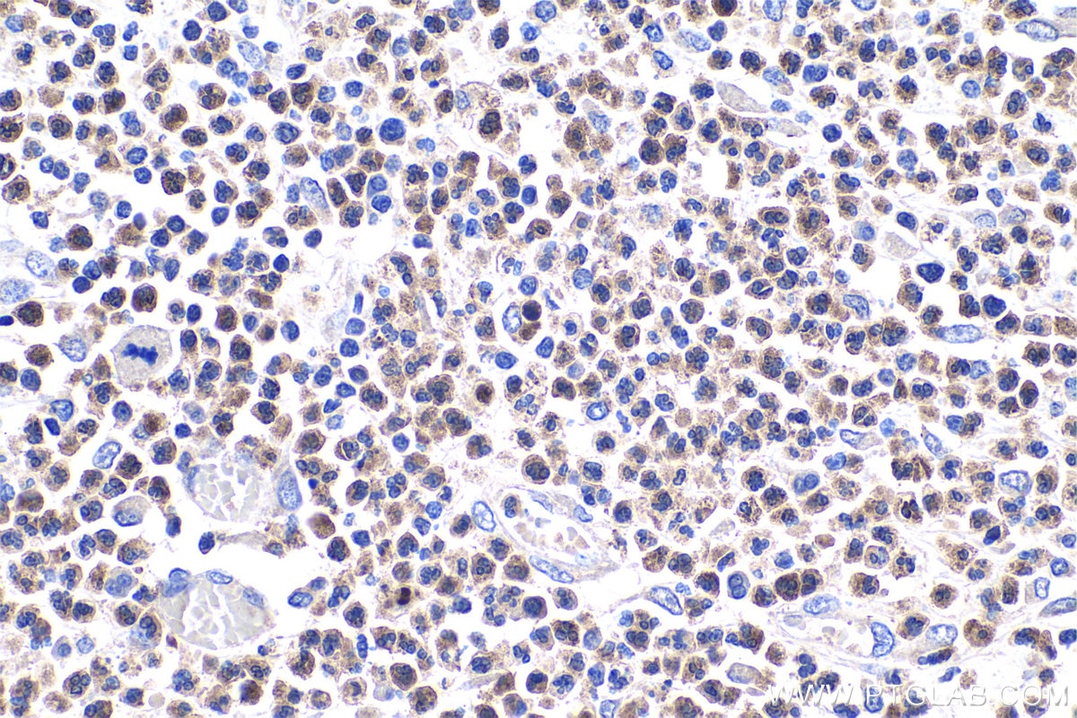 Immunohistochemical analysis of paraffin-embedded human colon cancer tissue slide using KHC0307 (NGAL/LCN2 IHC Kit).