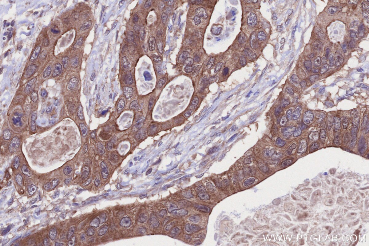 Immunohistochemical analysis of paraffin-embedded human stomach cancer tissue slide using KHC2678 (NGEF IHC Kit).
