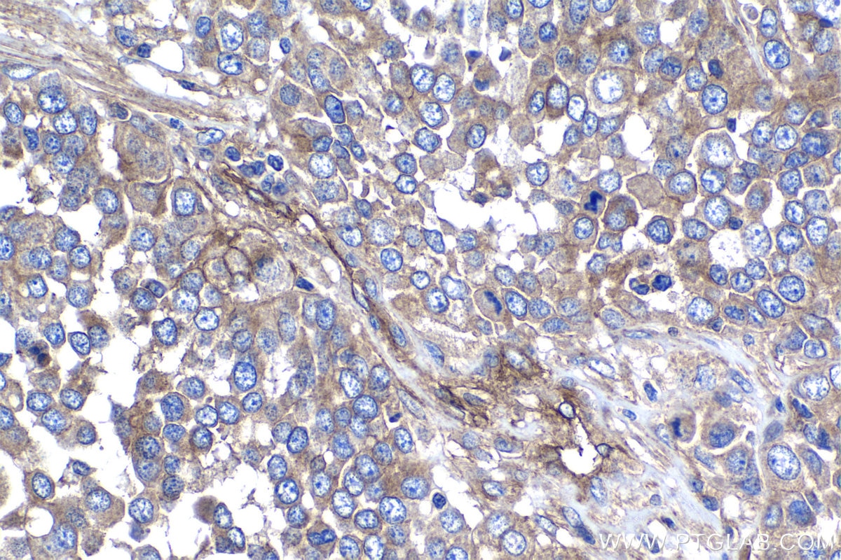 Immunohistochemical analysis of paraffin-embedded human ovary tumor tissue slide using KHC1288 (NHE1/SLC9A1 IHC Kit).