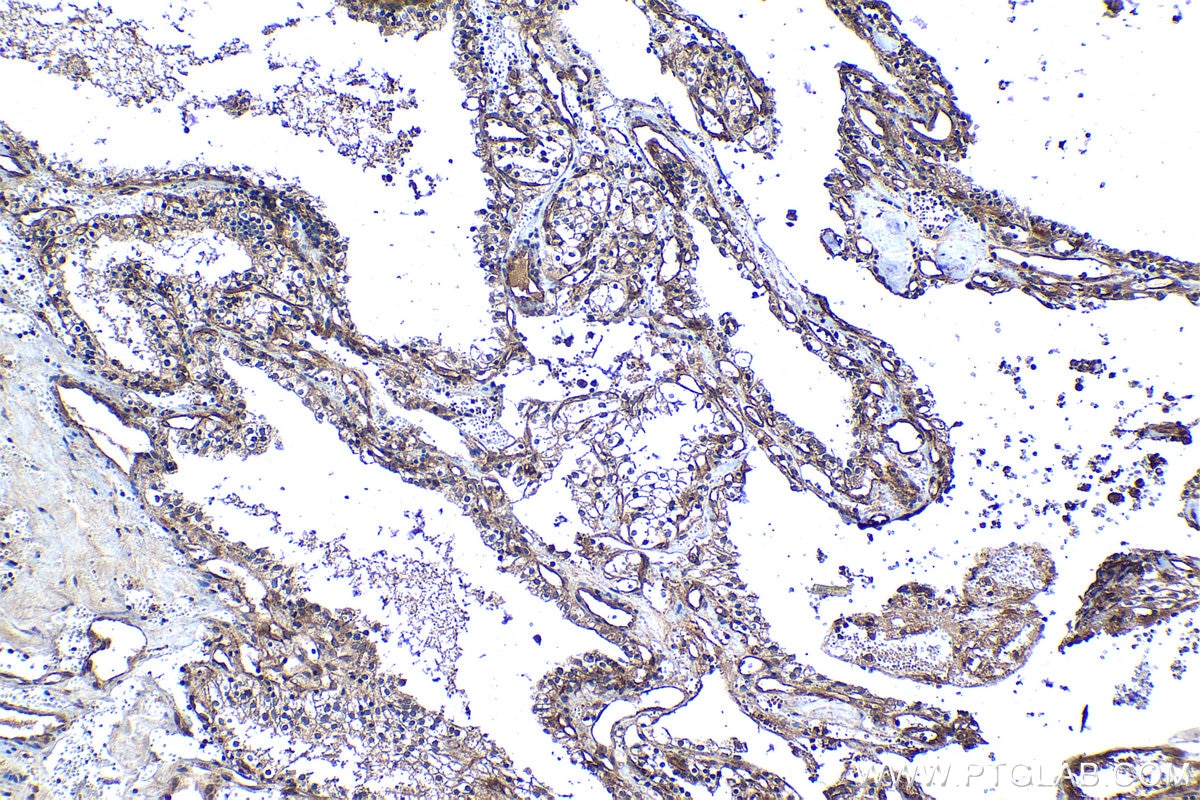 Immunohistochemical analysis of paraffin-embedded human renal cell carcinoma tissue slide using KHC1288 (NHE1/SLC9A1 IHC Kit).