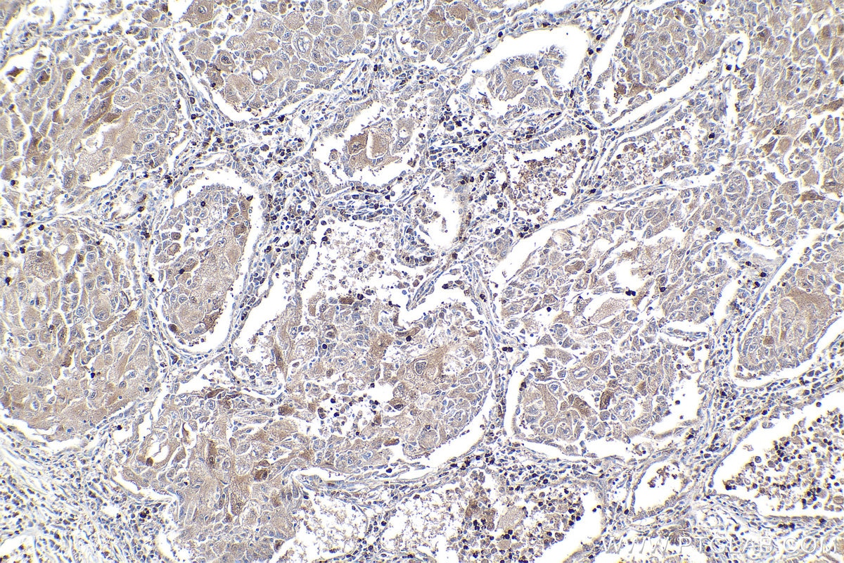 Immunohistochemical analysis of paraffin-embedded human lung cancer tissue slide using KHC1919 (NIF3L1 IHC Kit).