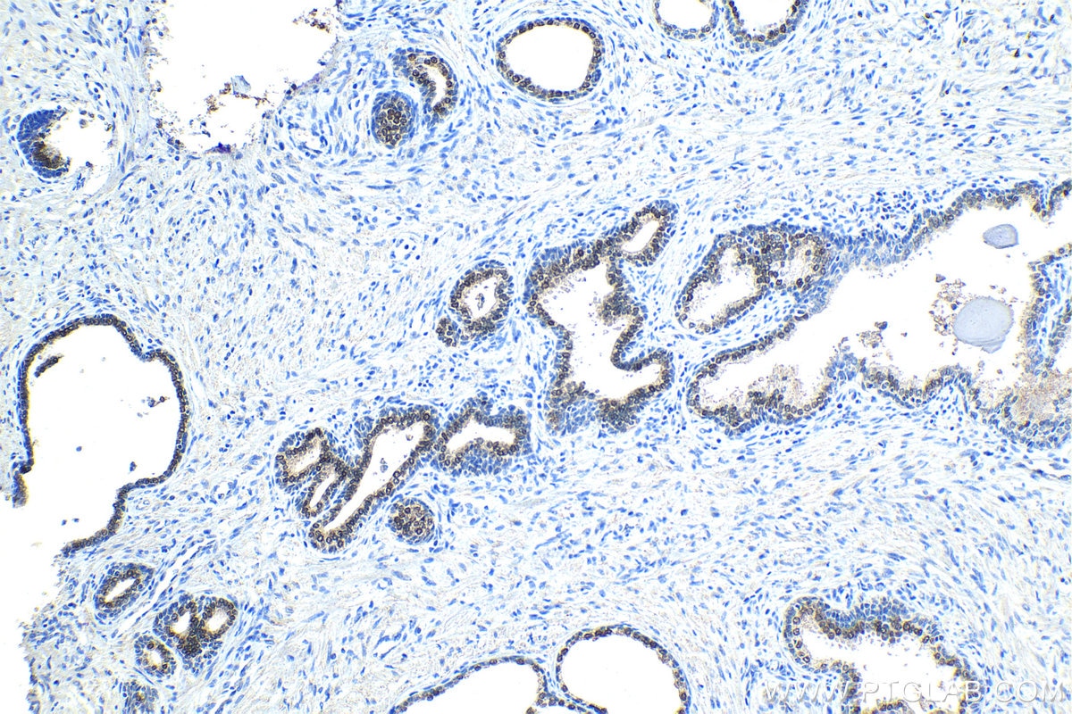 Immunohistochemical analysis of paraffin-embedded human prostate cancer tissue slide using KHC1162 (NKX3.1 IHC Kit).