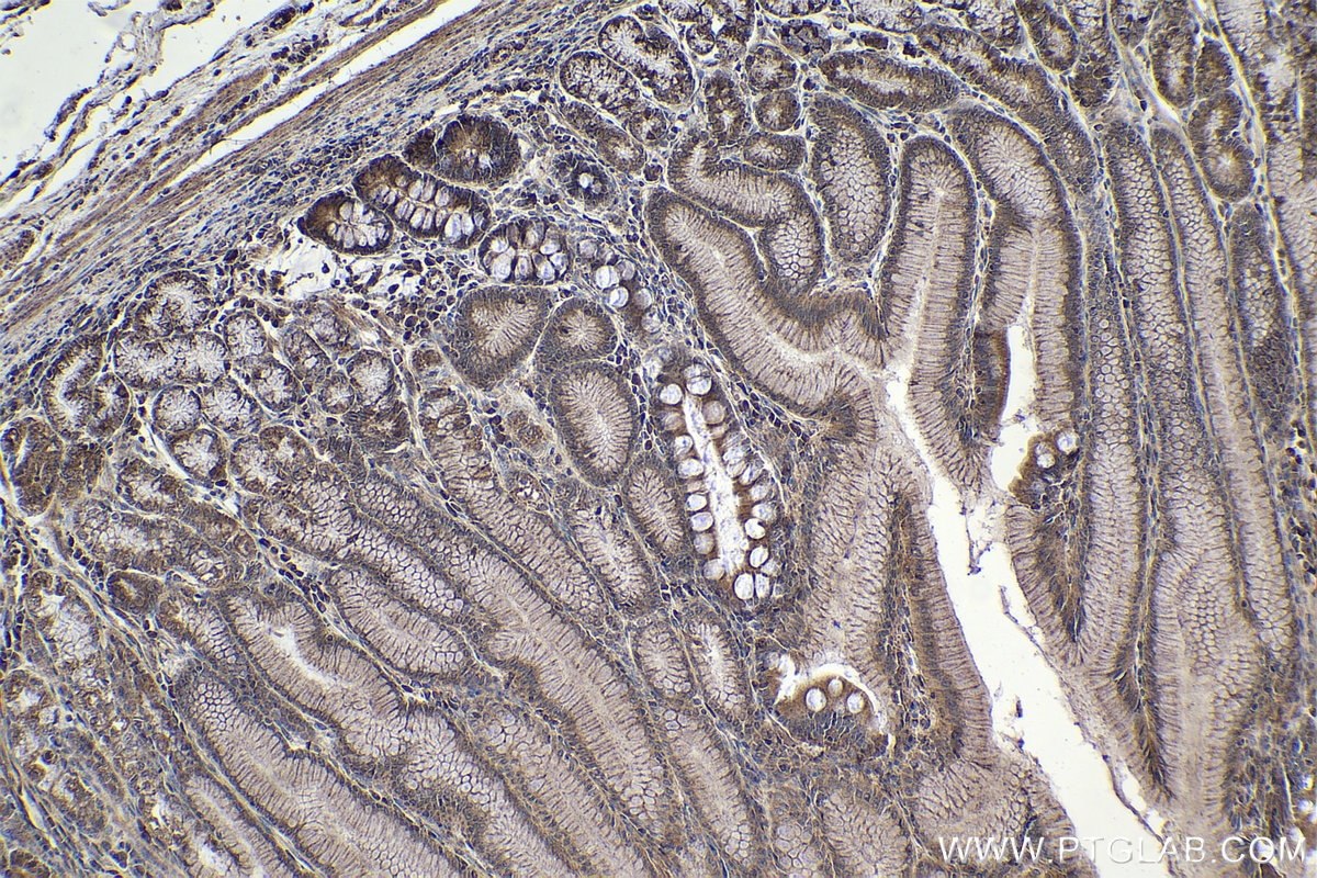 Immunohistochemical analysis of paraffin-embedded human stomach cancer tissue slide using KHC1913 (NLRP1 IHC Kit).