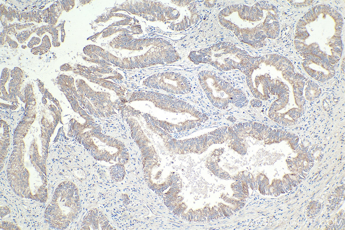 Immunohistochemical analysis of paraffin-embedded human pancreas cancer tissue slide using KHC1913 (NLRP1 IHC Kit).