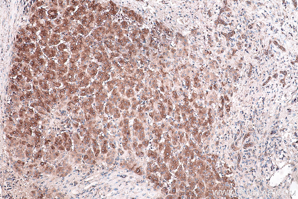 Immunohistochemical analysis of paraffin-embedded human liver cancer tissue slide using KHC0442 (NME1 IHC Kit).