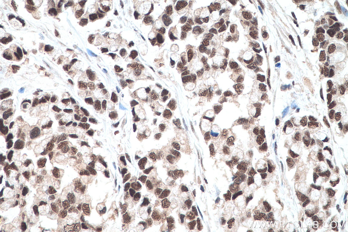 Immunohistochemical analysis of paraffin-embedded human colon cancer tissue slide using KHC0643 (NMNAT1 IHC Kit).