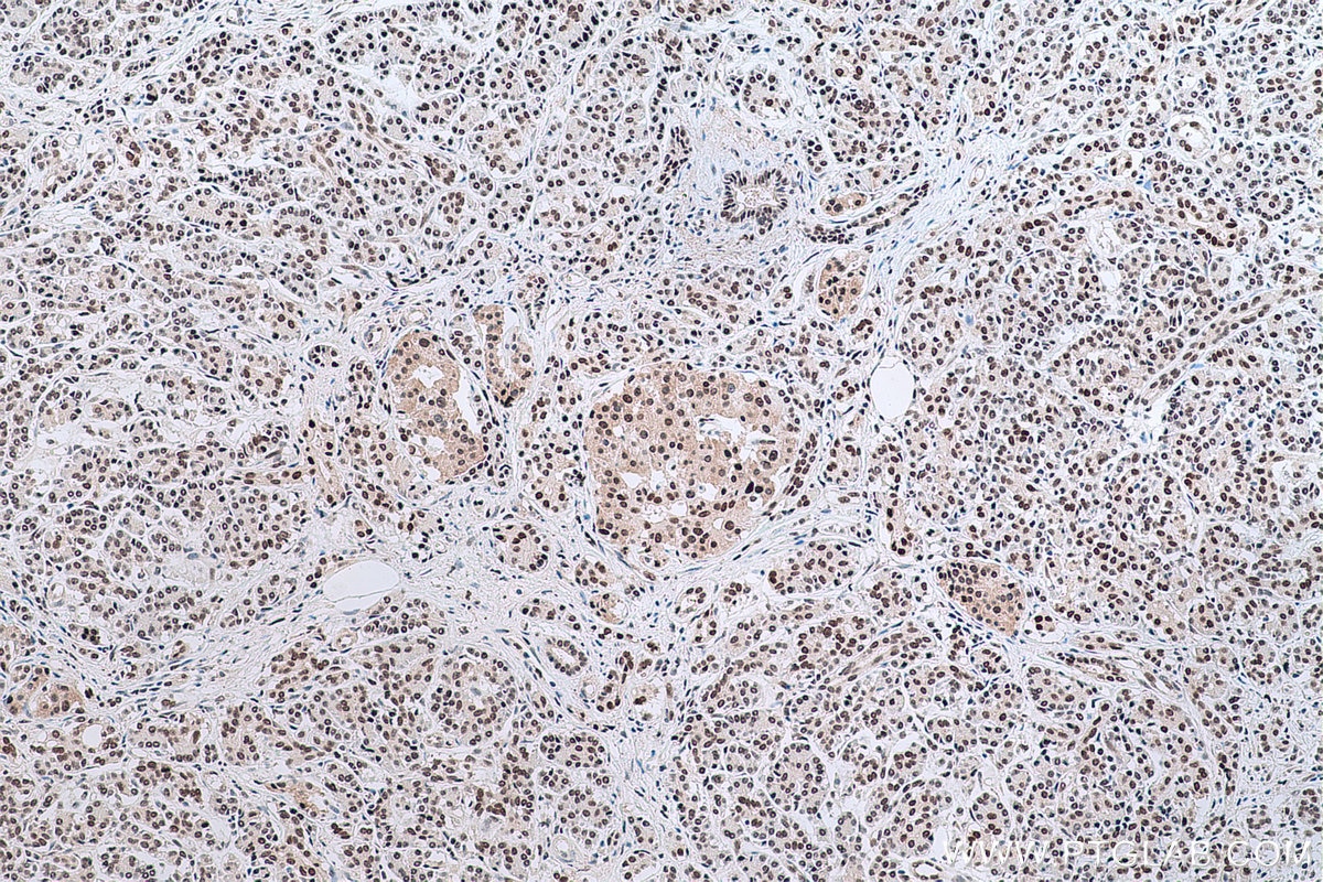 Immunohistochemical analysis of paraffin-embedded human pancreas cancer tissue slide using KHC0643 (NMNAT1 IHC Kit).