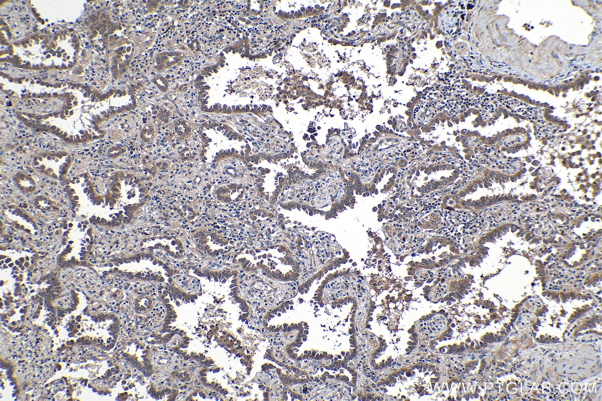 Immunohistochemical analysis of paraffin-embedded human lung cancer tissue slide using KHC1257 (NMRAL1 IHC Kit).