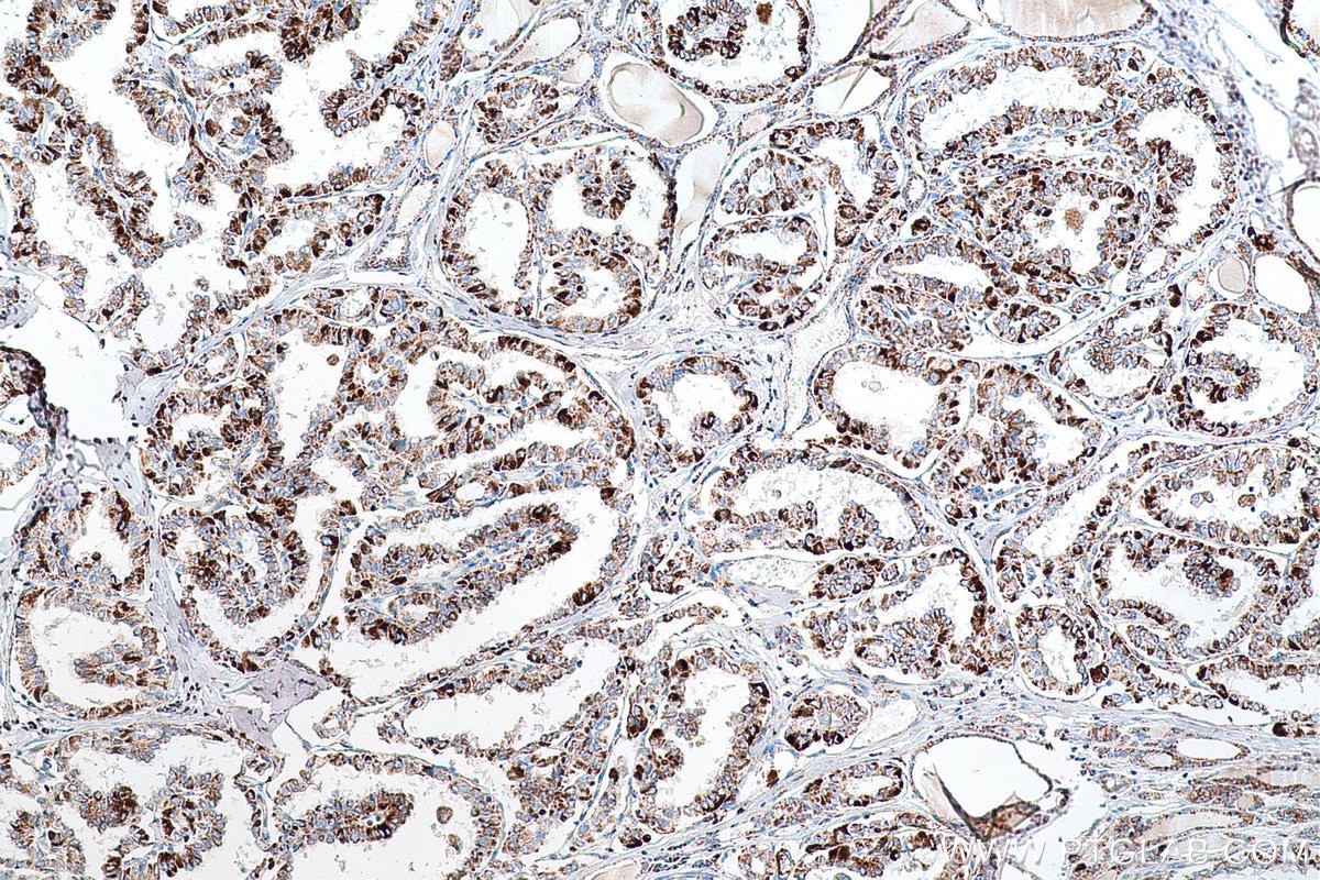Immunohistochemical analysis of paraffin-embedded human thyroid cancer tissue slide using KHC0645 (NNT IHC Kit).