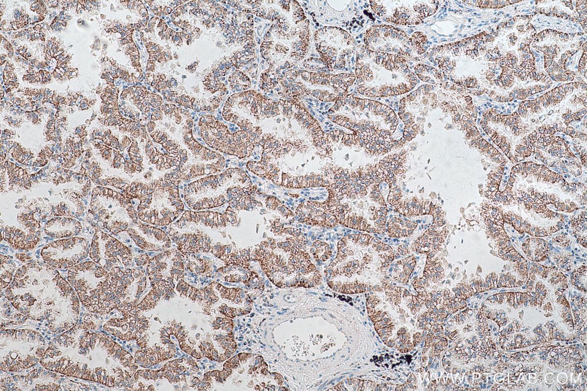 Immunohistochemical analysis of paraffin-embedded human lung cancer tissue slide using KHC0645 (NNT IHC Kit).