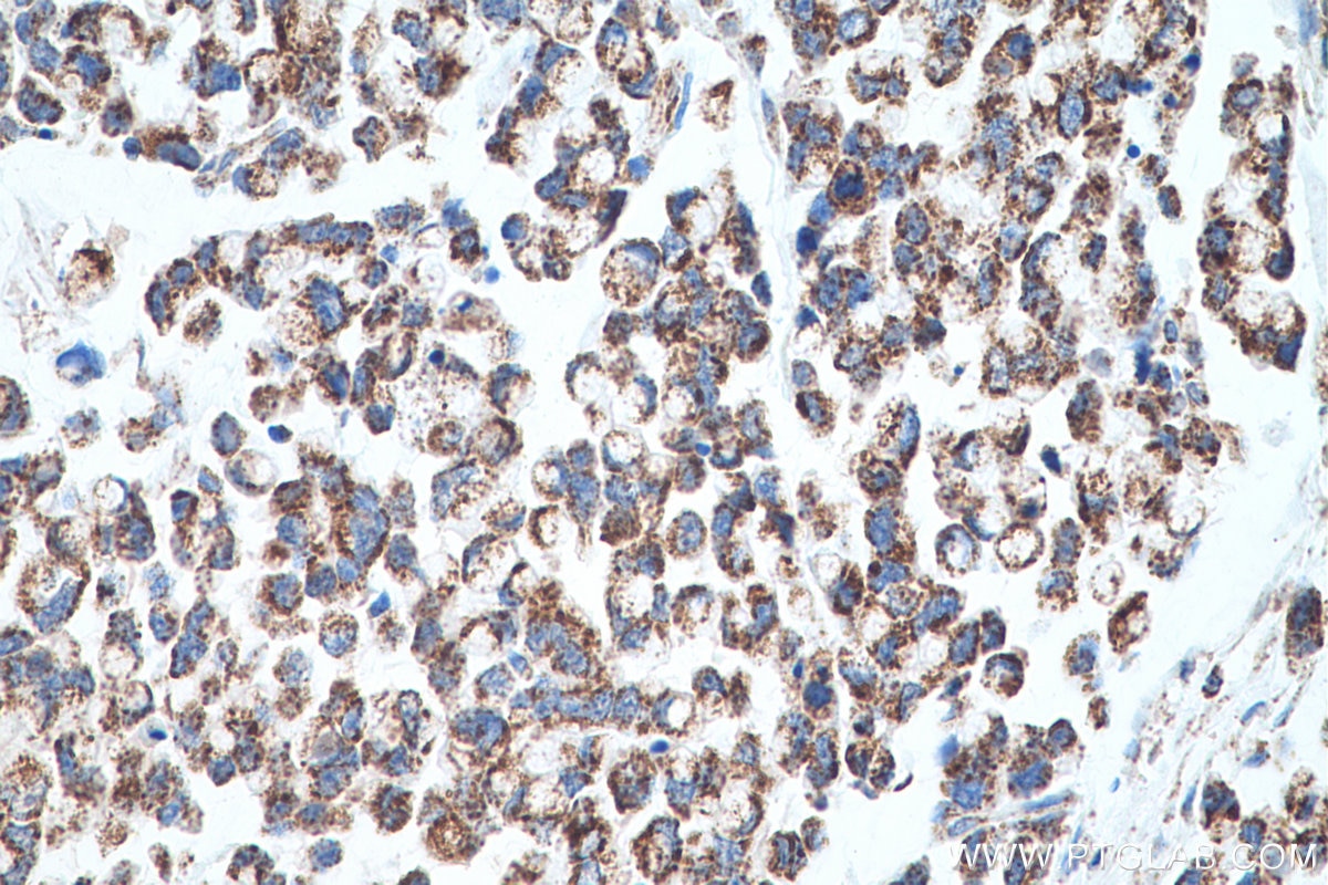 Immunohistochemical analysis of paraffin-embedded human colon cancer tissue slide using KHC0645 (NNT IHC Kit).