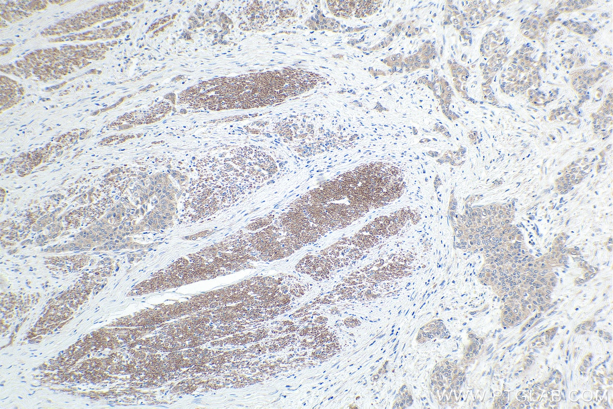 Immunohistochemical analysis of paraffin-embedded human urothelial carcinoma tissue slide using KHC1743 (NOLC1 IHC Kit).