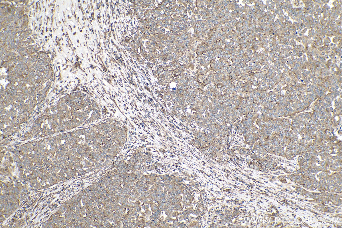 Immunohistochemical analysis of paraffin-embedded human ovary tumor tissue slide using KHC1061 (NOTCH1 IHC Kit).
