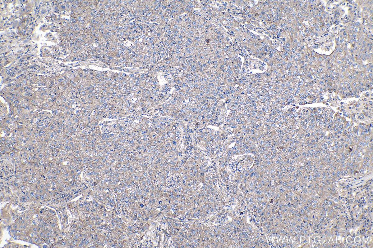 Immunohistochemical analysis of paraffin-embedded human lung cancer tissue slide using KHC1061 (NOTCH1 IHC Kit).