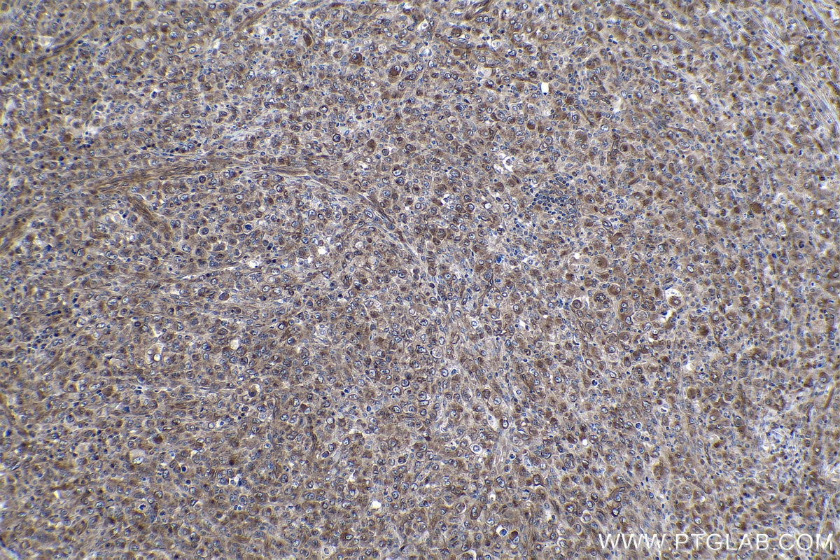 Immunohistochemical analysis of paraffin-embedded human lymphoma tissue slide using KHC1061 (NOTCH1 IHC Kit).