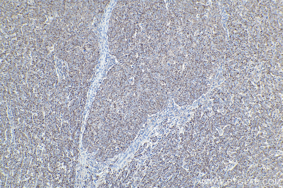 Immunohistochemical analysis of paraffin-embedded human ovary tumor tissue slide using KHC1954 (NOX4 IHC Kit).