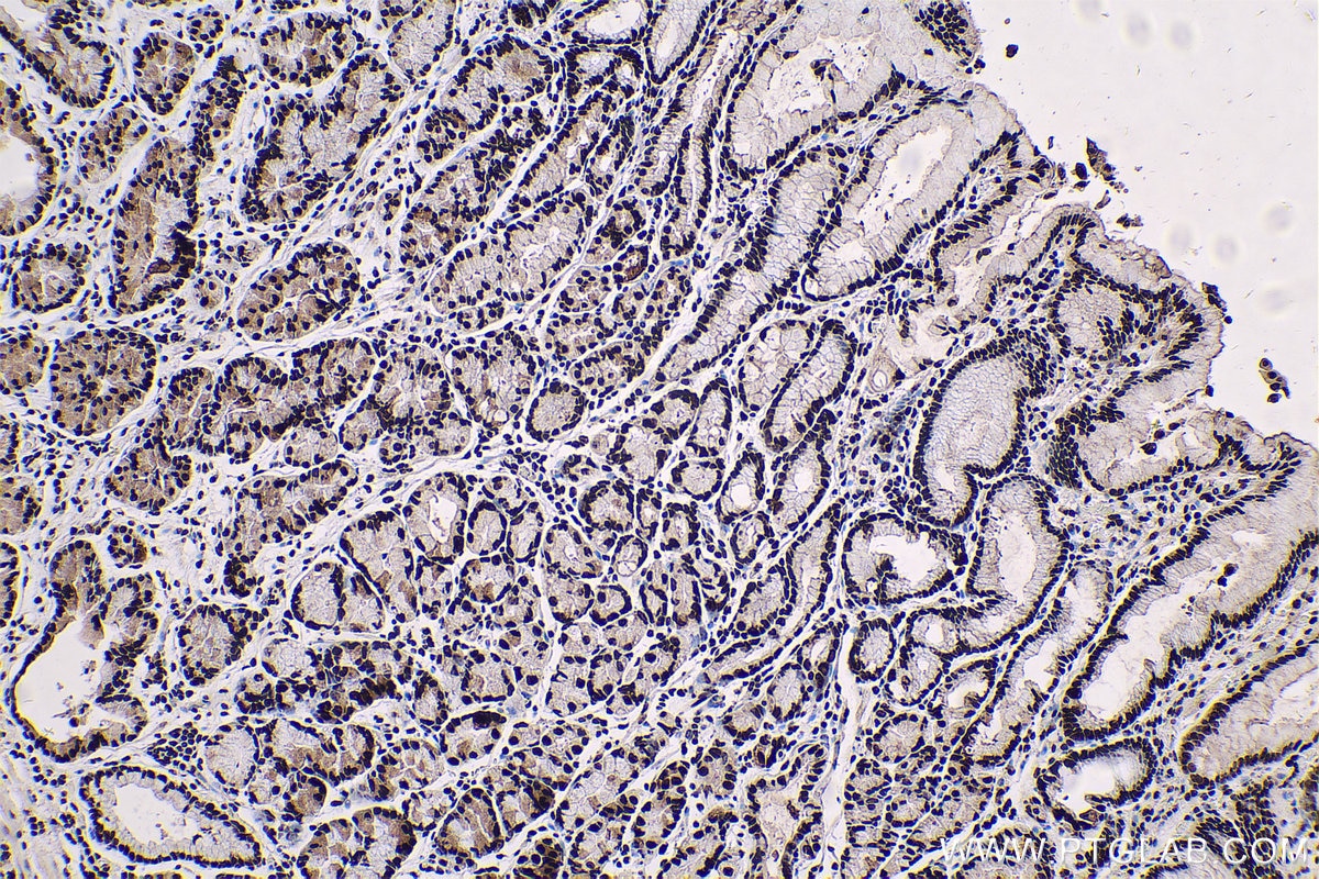 Immunohistochemical analysis of paraffin-embedded human stomach cancer tissue slide using KHC0621 (B23/NPM1 IHC Kit).