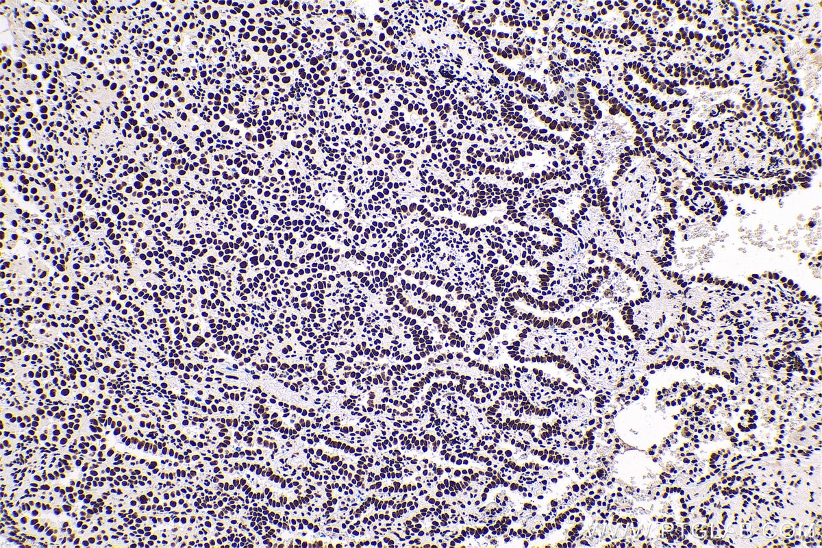 Immunohistochemical analysis of paraffin-embedded human lung cancer tissue slide using KHC0621 (B23/NPM1 IHC Kit).