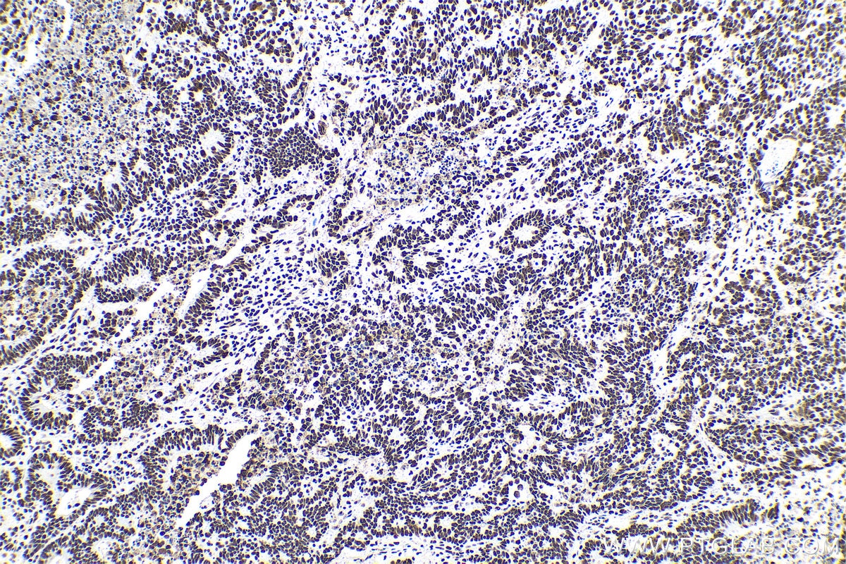 Immunohistochemical analysis of paraffin-embedded human colon cancer tissue slide using KHC0621 (B23/NPM1 IHC Kit).