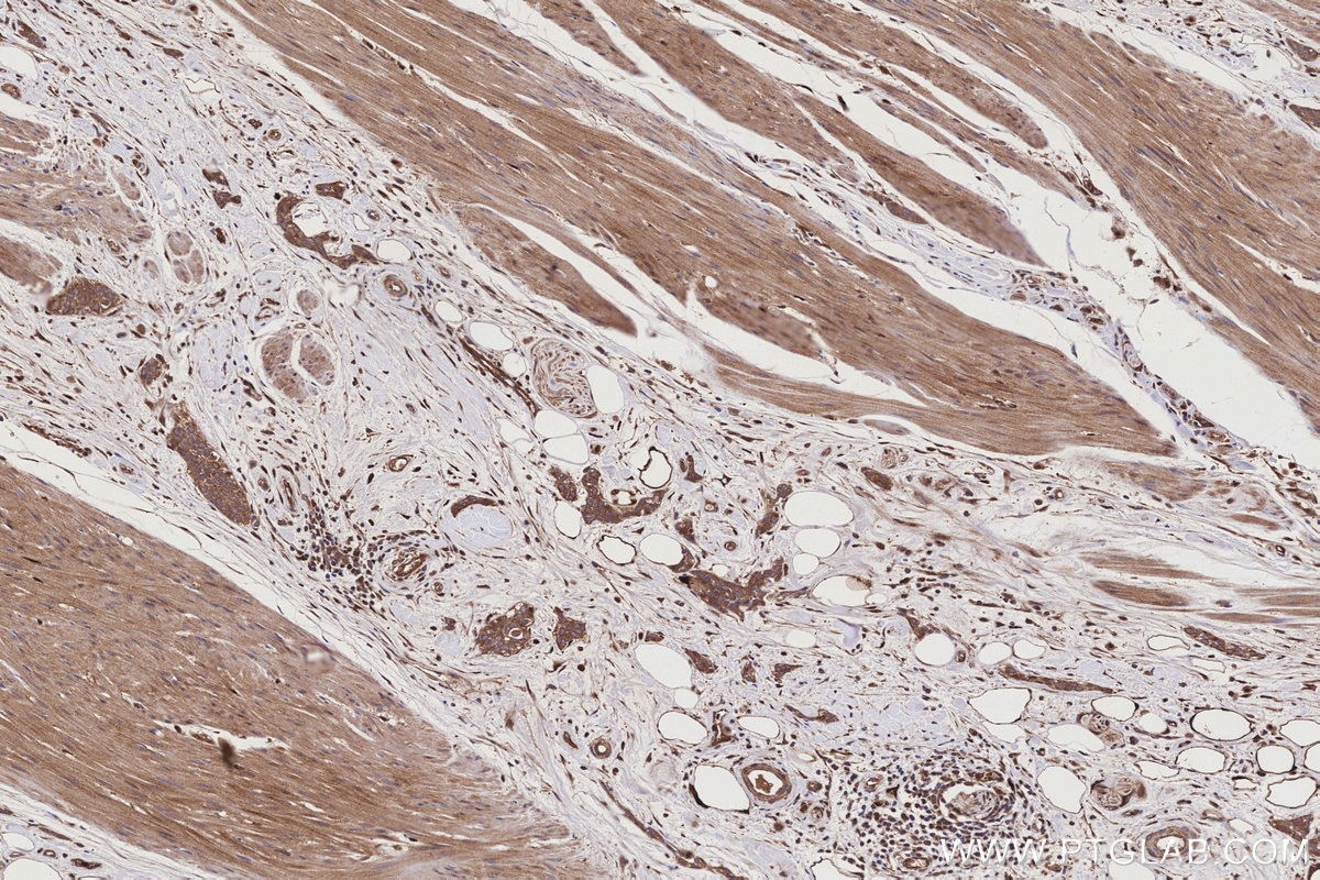 Immunohistochemical analysis of paraffin-embedded human urothelial carcinoma tissue slide using KHC3188 (NQO2 IHC Kit).