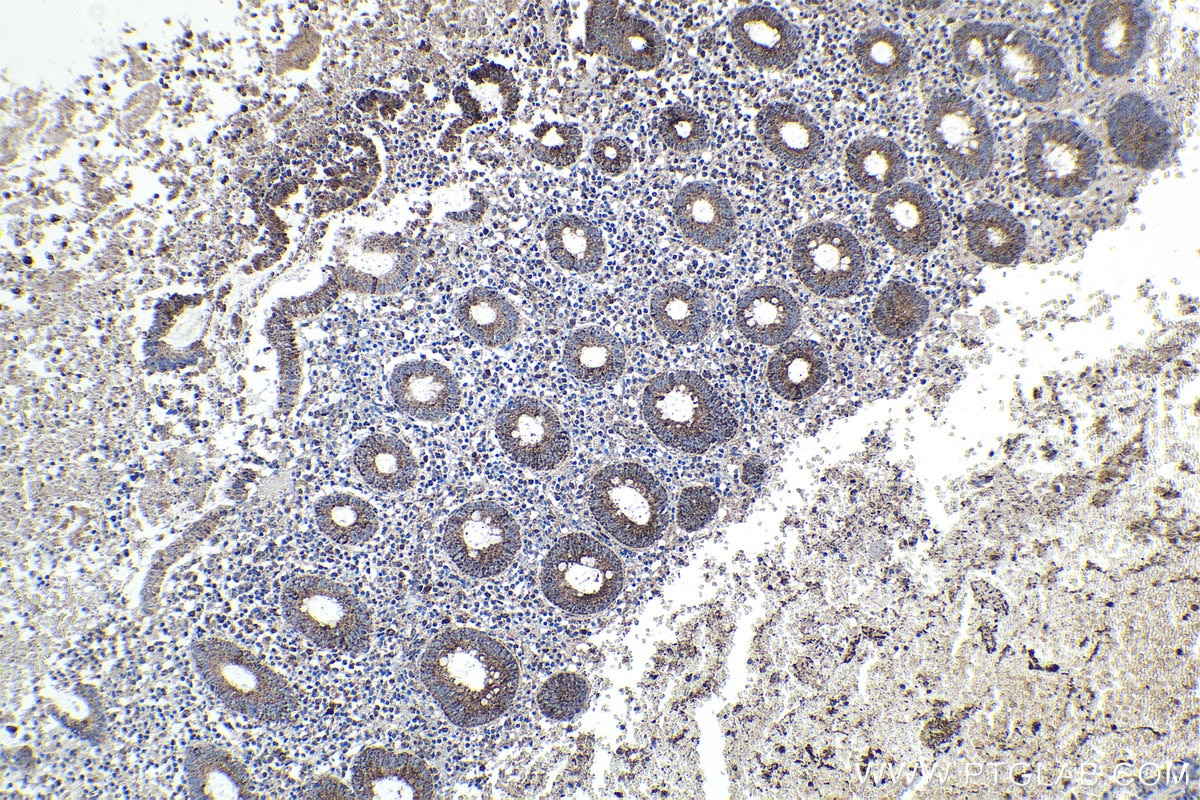 Immunohistochemical analysis of paraffin-embedded human appendicitis tissue slide using KHC1702 (NR1H3 IHC Kit).