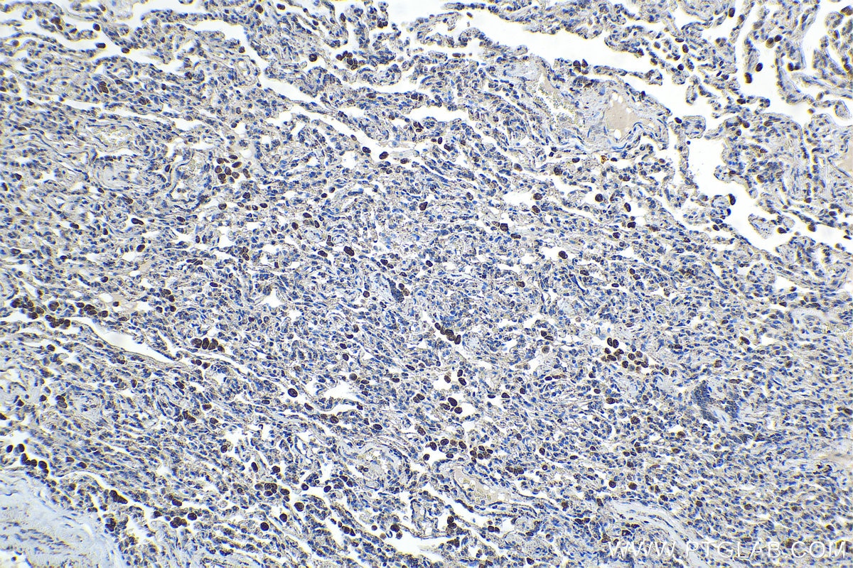 Immunohistochemical analysis of paraffin-embedded human lung cancer tissue slide using KHC1702 (NR1H3 IHC Kit).
