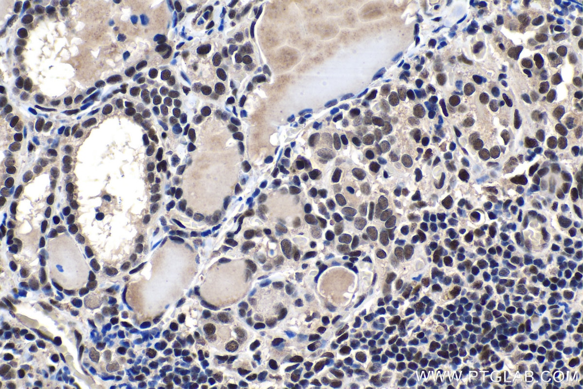 Immunohistochemical analysis of paraffin-embedded human thyroid cancer tissue slide using KHC1507 (NR3C1 IHC Kit).