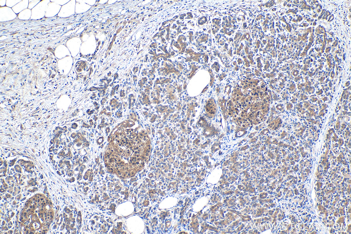 Immunohistochemical analysis of paraffin-embedded human pancreas cancer tissue slide using KHC1514 (NR3C2 IHC Kit).