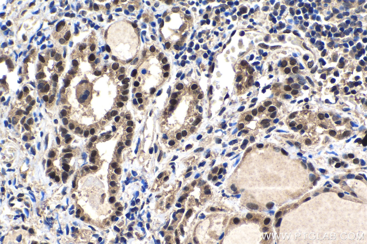 Immunohistochemical analysis of paraffin-embedded human thyroid cancer tissue slide using KHC1514 (NR3C2 IHC Kit).