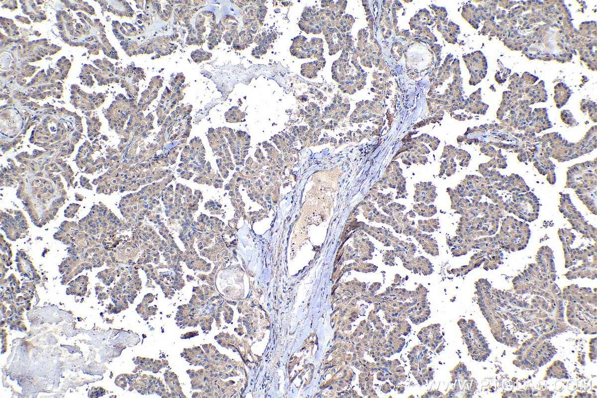 Immunohistochemical analysis of paraffin-embedded human thyroid cancer tissue slide using KHC1558 (NR4A1 IHC Kit).