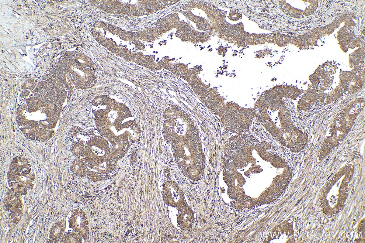 Immunohistochemical analysis of paraffin-embedded human pancreas cancer tissue slide using KHC1558 (NR4A1 IHC Kit).