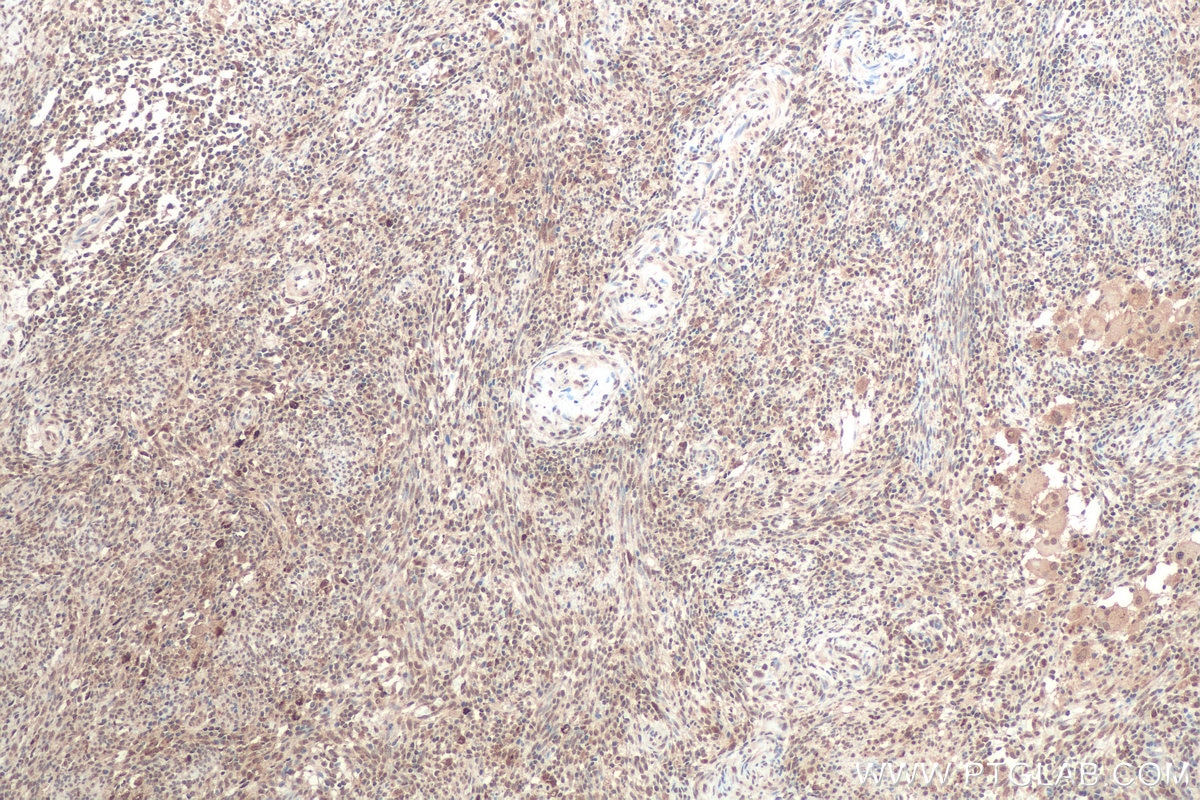 Immunohistochemical analysis of paraffin-embedded human cervical cancer tissue slide using KHC0803 (NR4A2 IHC Kit).