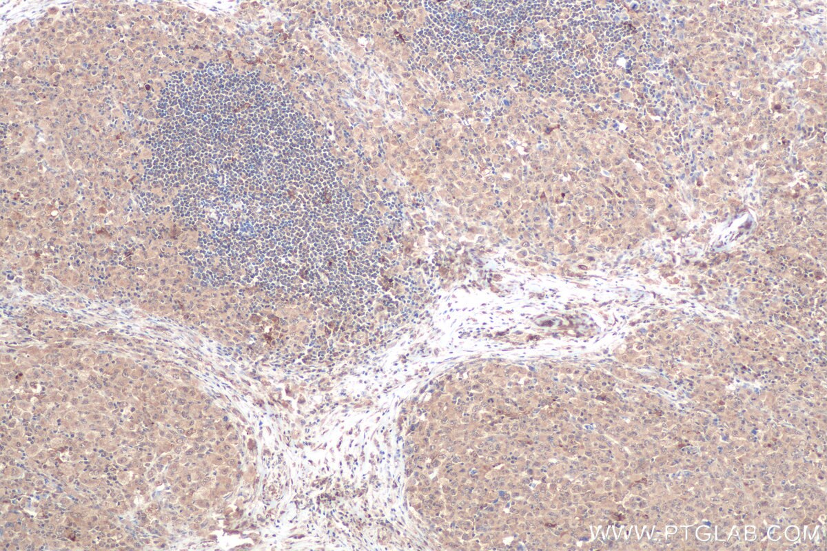 Immunohistochemical analysis of paraffin-embedded human lymphoma tissue slide using KHC0803 (NR4A2 IHC Kit).