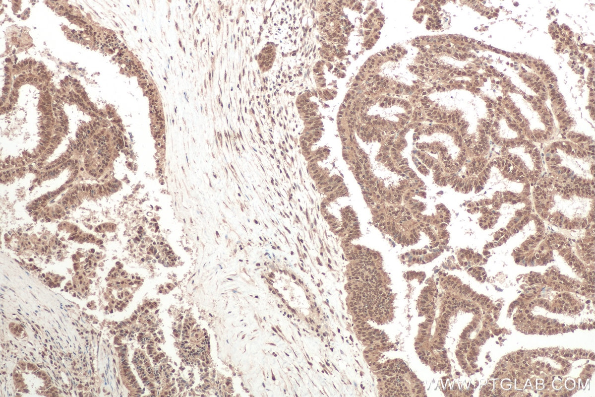 Immunohistochemical analysis of paraffin-embedded human ovary tumor tissue slide using KHC0803 (NR4A2 IHC Kit).