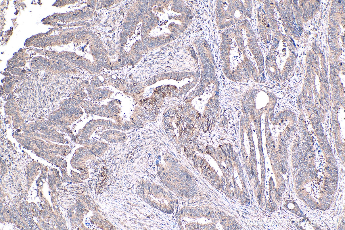 Immunohistochemical analysis of paraffin-embedded human colon cancer tissue slide using KHC0279 (NRAS IHC Kit).