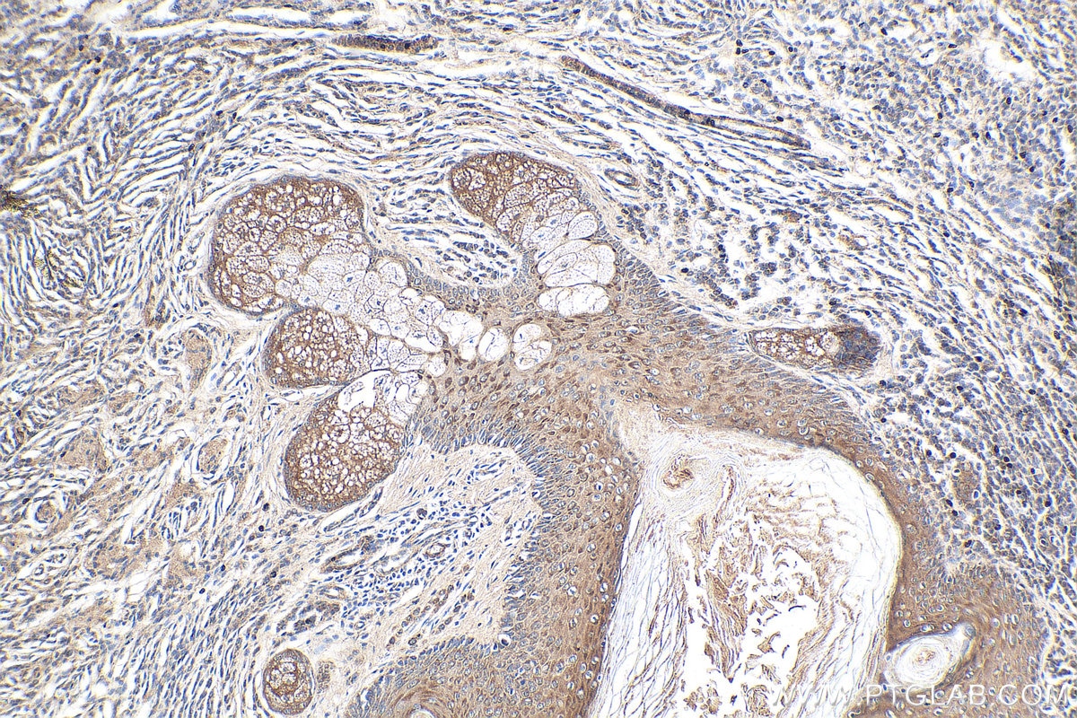 Immunohistochemical analysis of paraffin-embedded human malignant melanoma tissue slide using KHC0279 (NRAS IHC Kit).