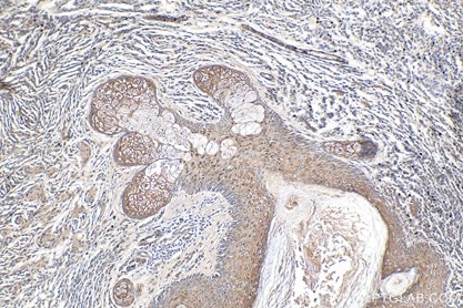 IHC analysis of human malignant melanoma tissue using NRAS IHC