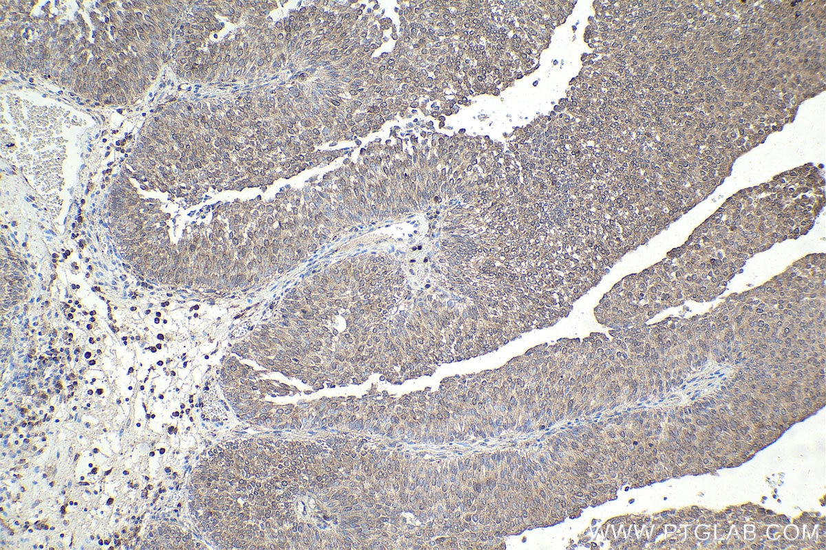 Immunohistochemical analysis of paraffin-embedded human urothelial carcinoma tissue slide using KHC1871 (NRBF2 IHC Kit).