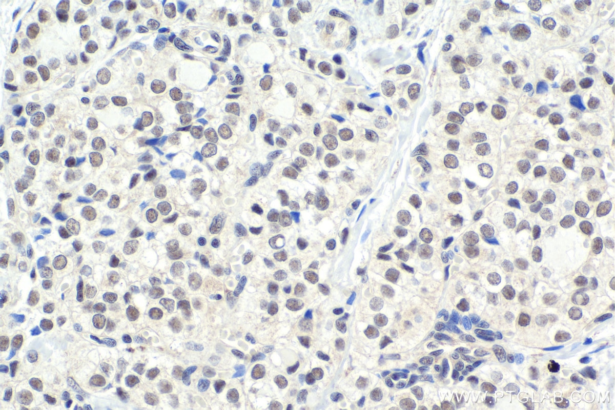 Immunohistochemical analysis of paraffin-embedded human thyroid cancer tissue slide using KHC1763 (NRF1 IHC Kit).