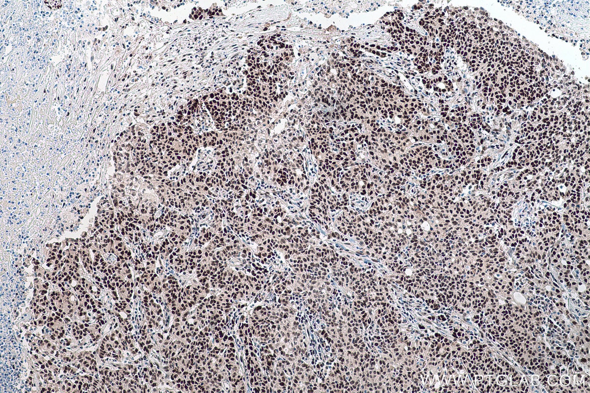 Immunohistochemical analysis of paraffin-embedded human stomach cancer tissue slide using KHC0172 (NSUN2 IHC Kit).